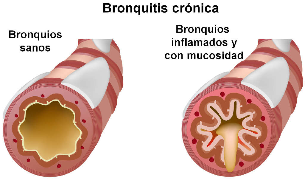 clinica internacional bronquitis cronica dibujo