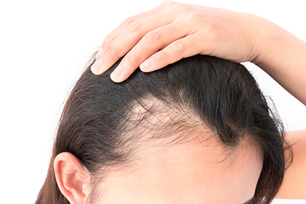 clinica internacional alopecia androgenetica caida cabello