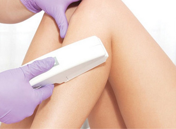 clinica internacional dermatologia estrias laser