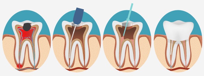 clinica internacional odontologia tratamiento endodoncia