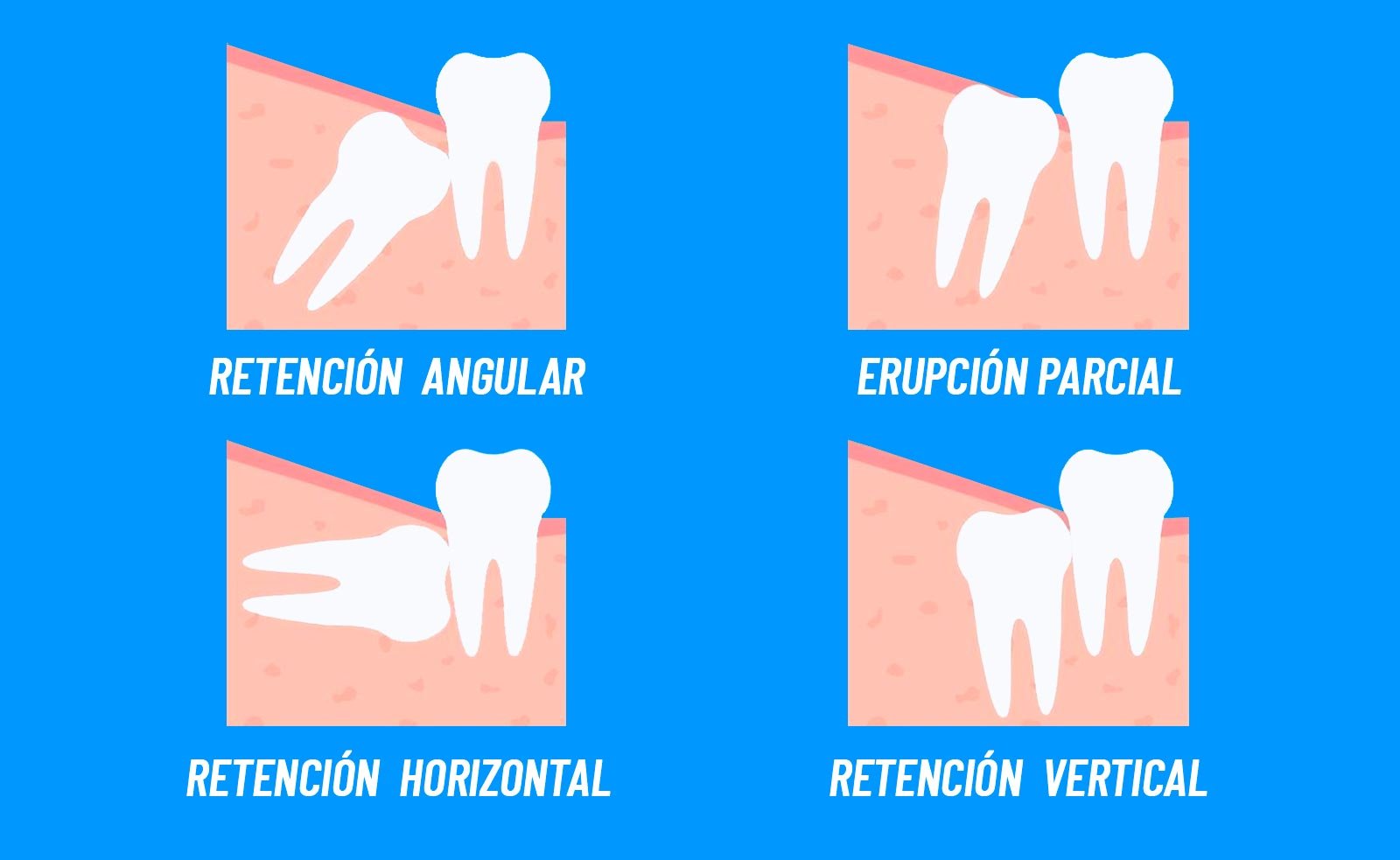 odontología muelas juicio tipos clínica internacional