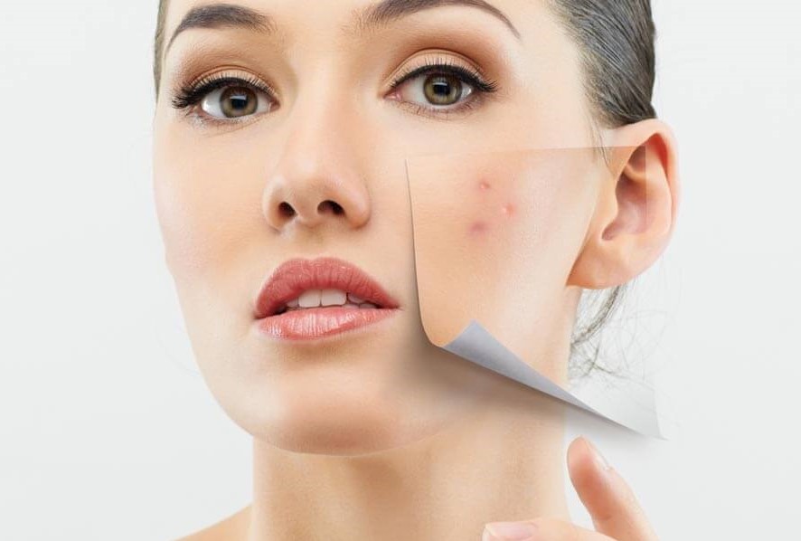 clinica internacional dermatologia acne cuidados