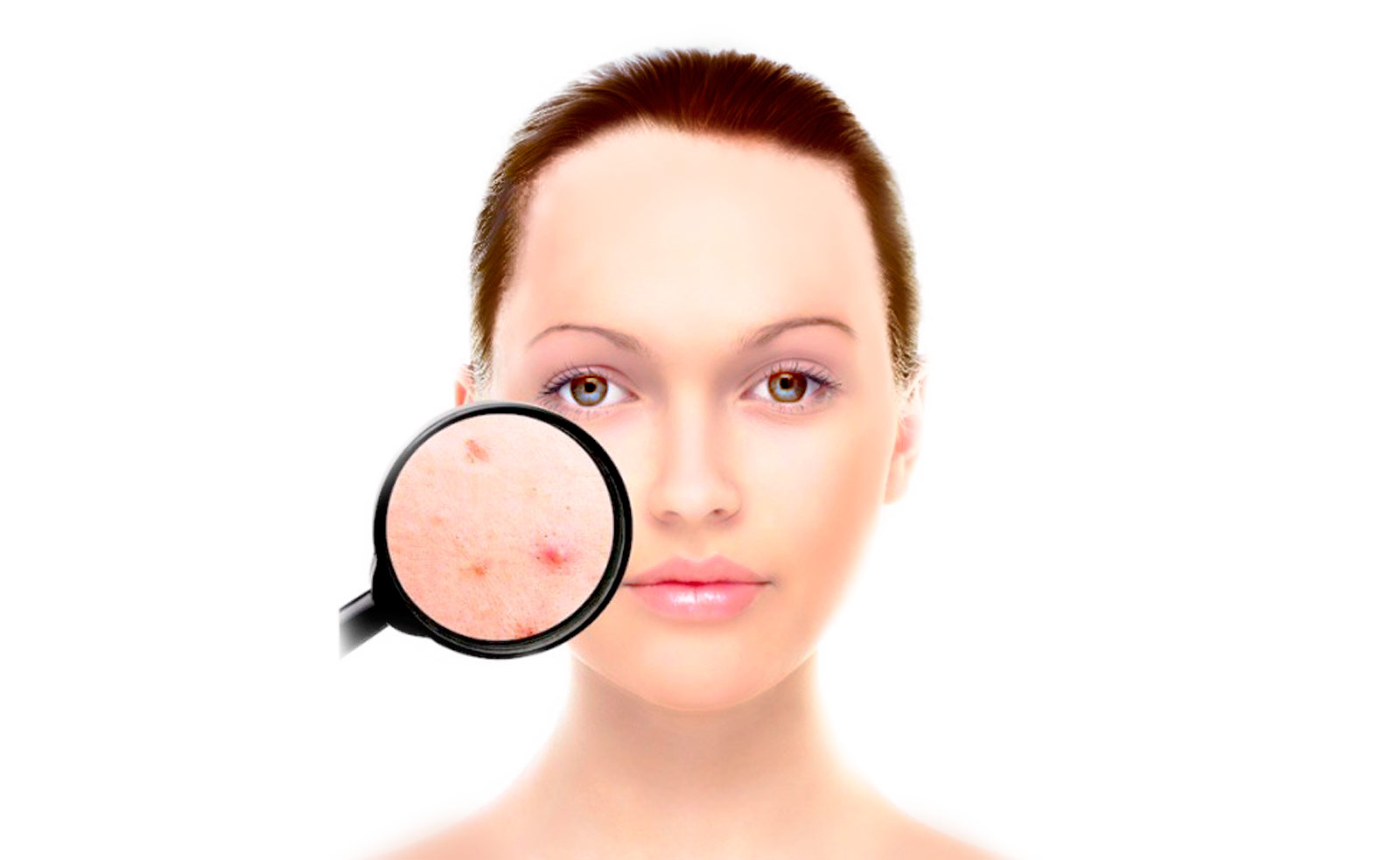 dermatología tratamiento acné clínica internacional