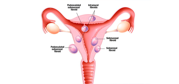 clinica internacional ginecología tipos miomas