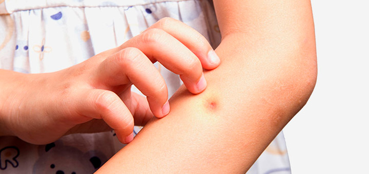 como tratar picaduras insectos