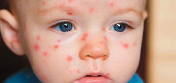 identificar enfermedades comunes ninos varicela