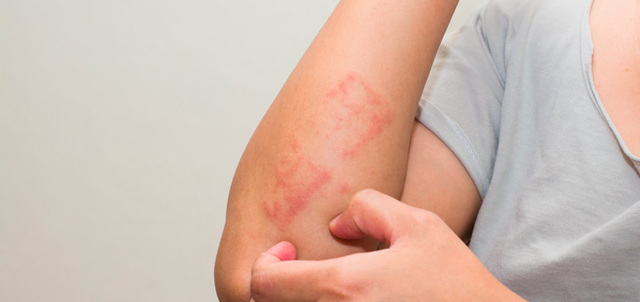 que es dermatitis como tratar tipos dermatitis