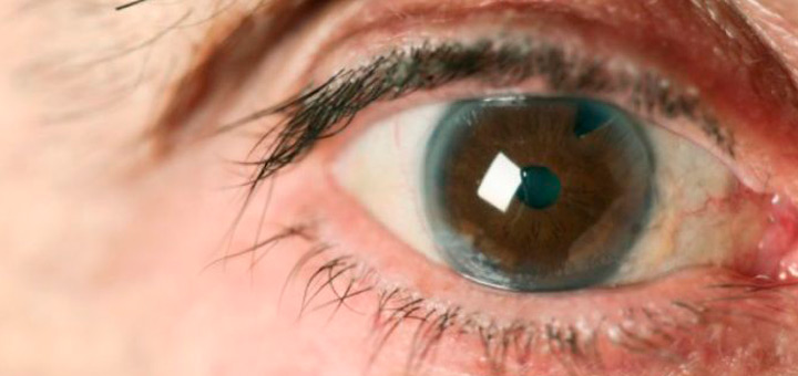 que son cataratas en ojos factores afectan vision