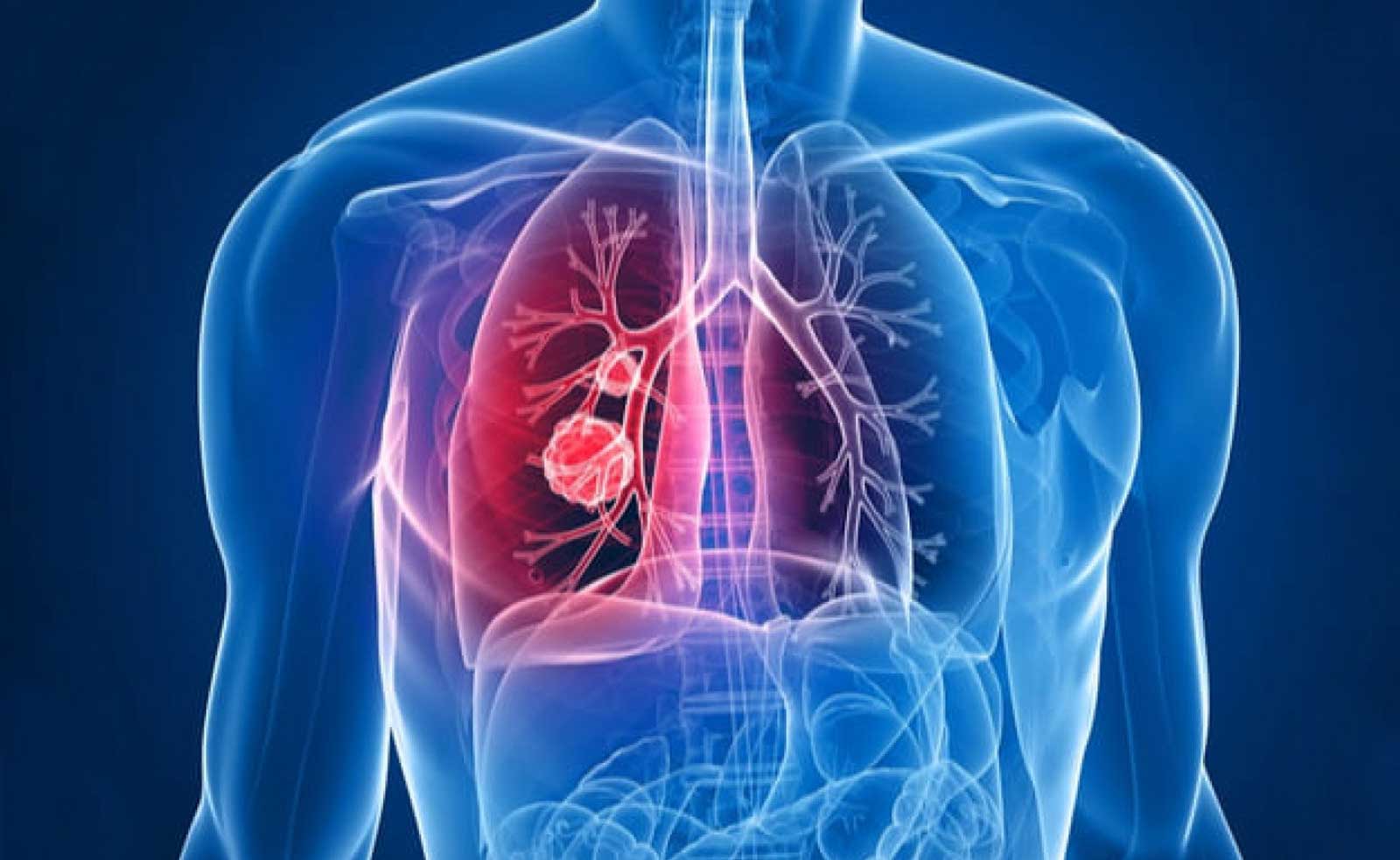 conoce embolia pulmonar como puede afectar salud