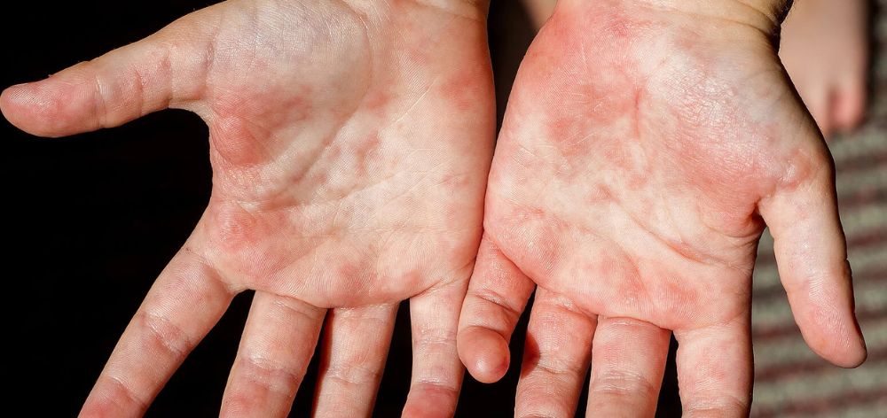 causas dermatitis contacto clinica internacional