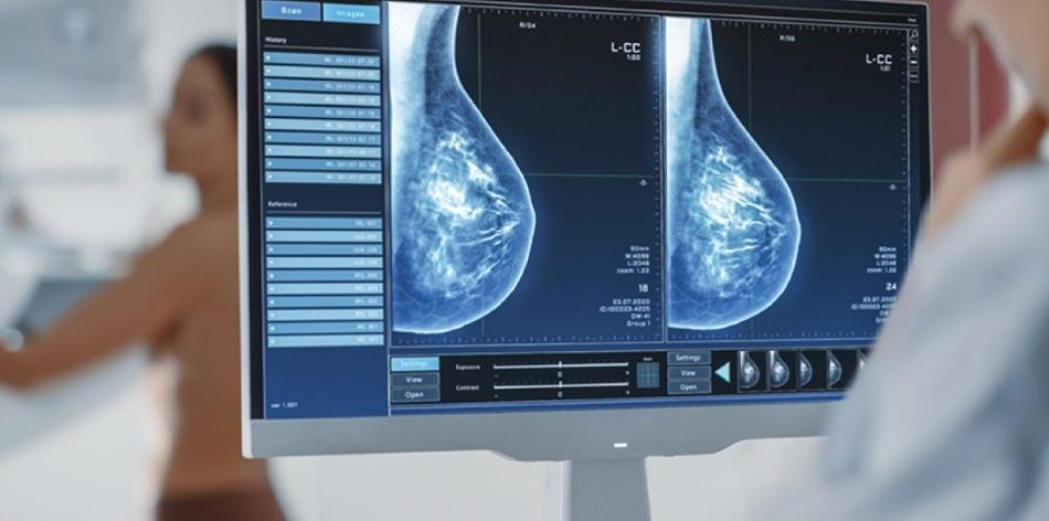 radiacion mamografias clinica internacional